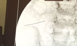 Ağrıdan kıvranan çocuk ameliyata alındı: Bağırsağından toplu iğne çıktı