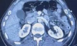 Midelerinde uyuşturucu ile yakalandılar