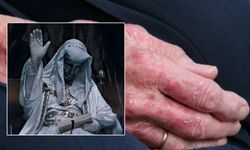 40 yıl sonra ilk: Romanya ve Hırvatistan'da cüzzam vakaları görüldü