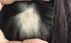 Saçkıran nedir? Belirtileri nelerdir, Kimlerde görülür? Tedavisi var mı?