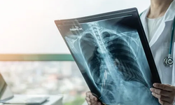 Akciğer kanseri için kritik uyarı: Yakalananların sayısında patlama yaşanıyor