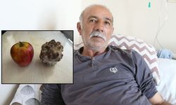 Doktorlar bile inanamadı! Mesaneden elma büyüklüğünde taş çıktı!