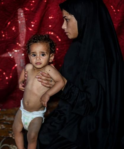 Gazze'de çadırda doğan 18 aylık Fatma yaşam mücadelesi veriyor