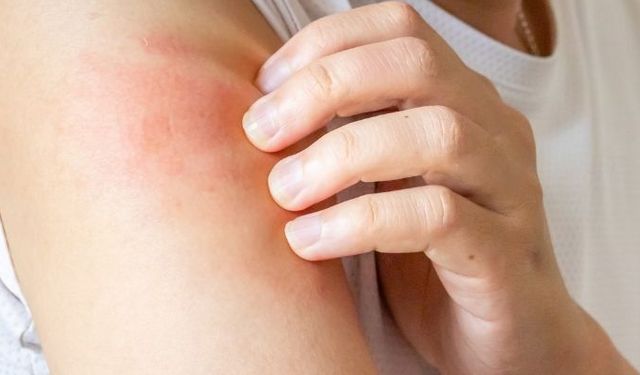 Egzama nedir? Egzamanın belirtileri nelerdir? Buluşacı mıdır?