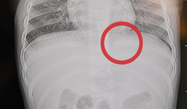 Sırtüstü yatamıyor, sürekli ağlıyordu: 1 yaşındaki bebeğin sırtından çıkan '2 santimlik tehlike' şoke etti!