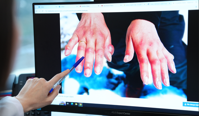 Soğuk havalardaki görünmeyen tehlike: Uzuv kaybı