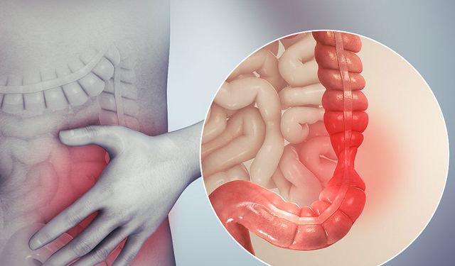 Huzursuz bağırsak sendromu (IBS) hakkında bilmeniz gereken her şey