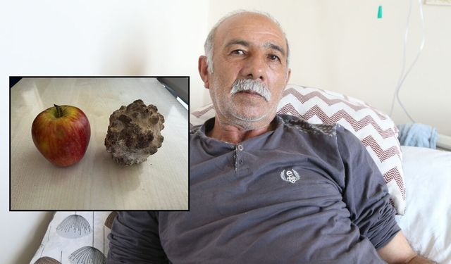 Doktorlar bile inanamadı! Mesaneden elma büyüklüğünde taş çıktı!