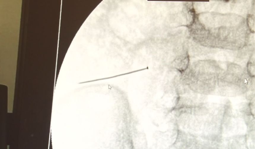 Ağrıdan kıvranan çocuk ameliyata alındı: Bağırsağından toplu iğne çıktı