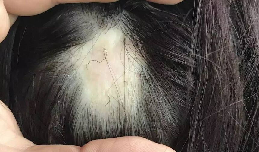 Saçkıran nedir? Belirtileri nelerdir, Kimlerde görülür? Tedavisi var mı?