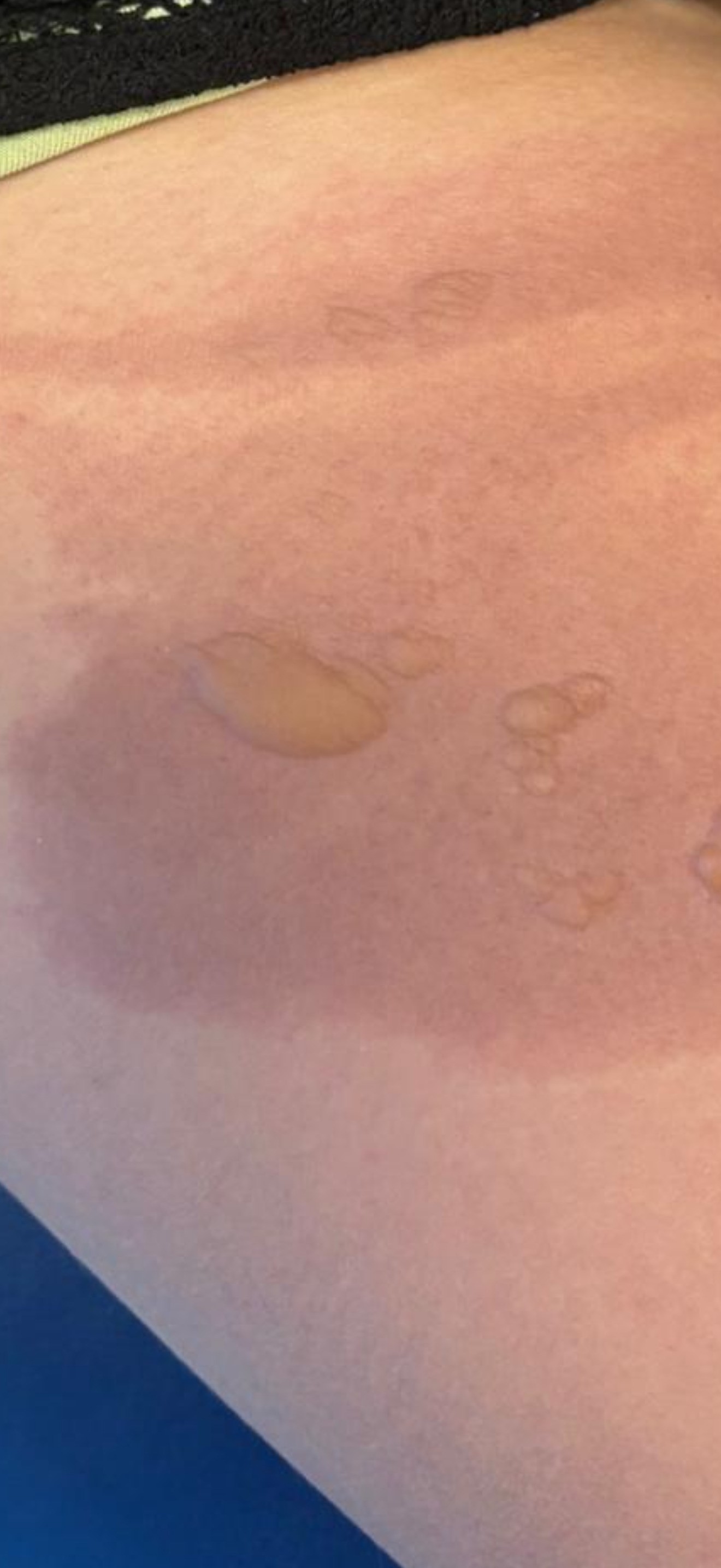 Sicak Su Torbasi Patladi (2)