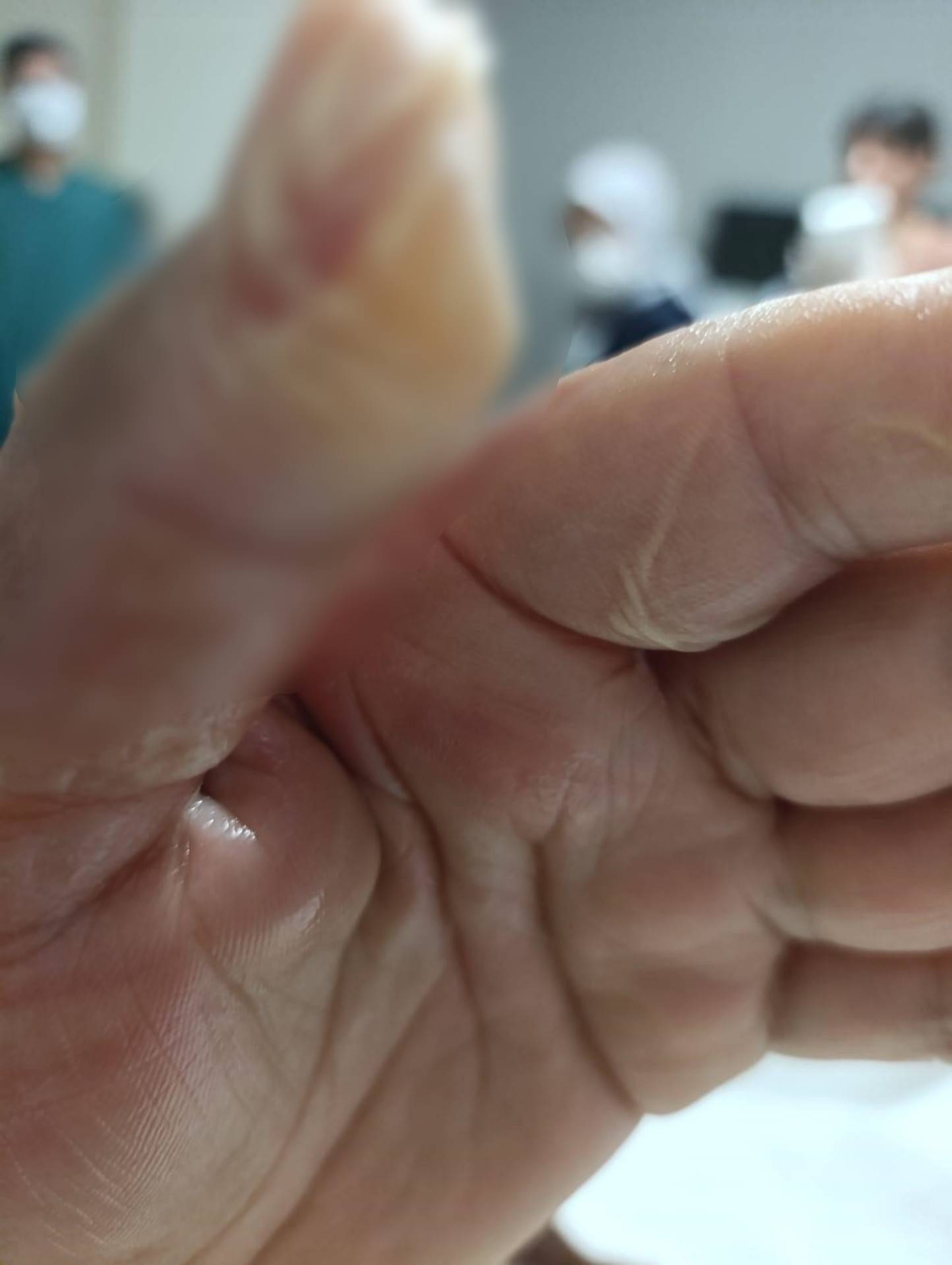 Sicak Su Torbasi Patladi Vücudunun Yuzde 30U Yandi 3