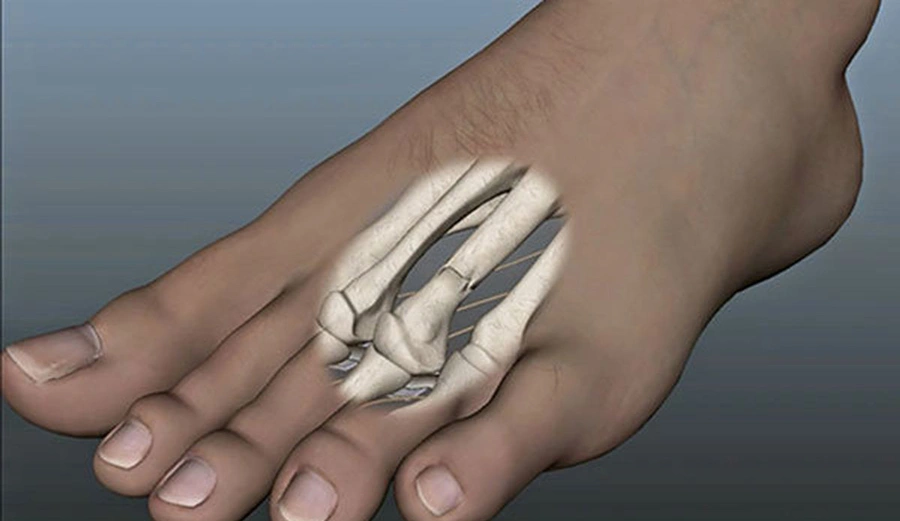 Stres Kırığı Görsel