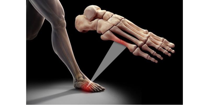 Stres Kiriği Nedi̇r