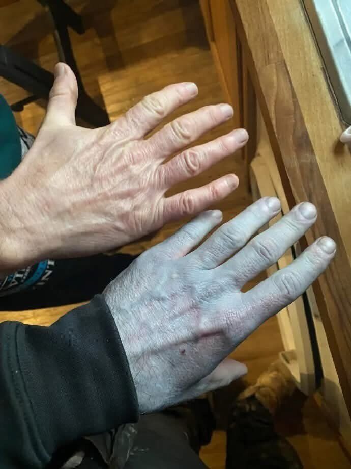 Teni Maviye Dönenen Adamın Sırrı Çözüldü